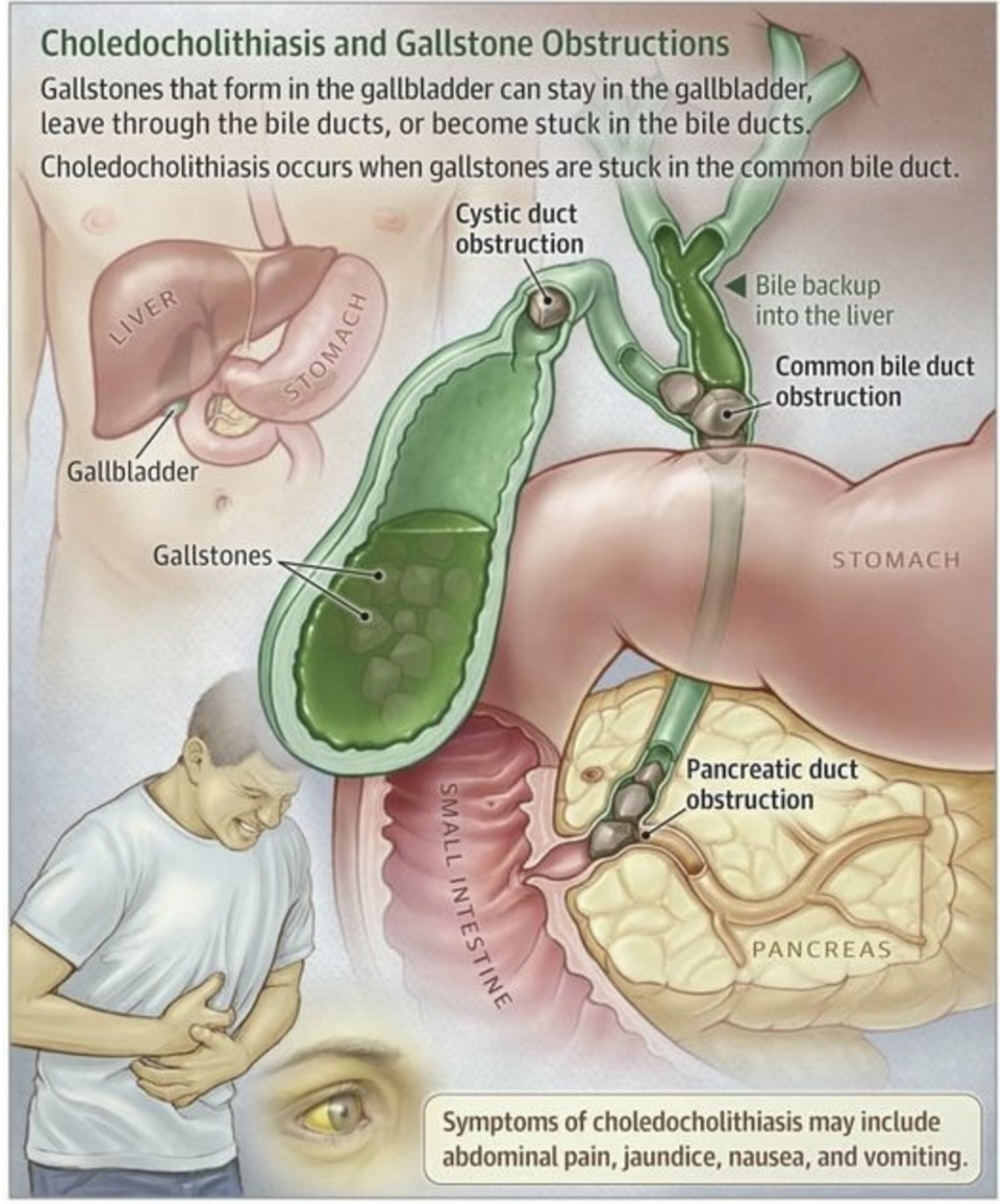 Gallbladder Surgery